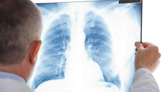 What are Pulmonary Nodules?
